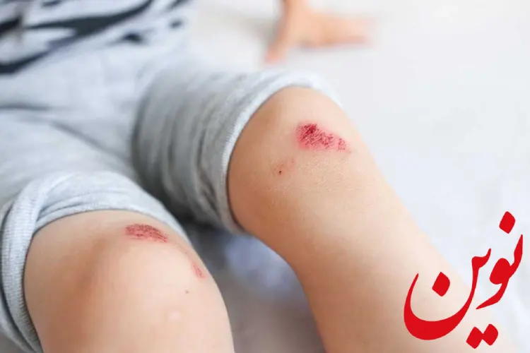 درمان سوختگی پوست بر اثر کشیدگی رو فرش